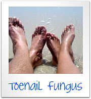 toenail fungus